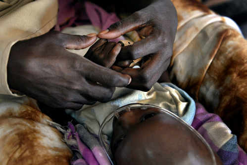 Unas manos de adulto sujetan las de un bebé malnutrido