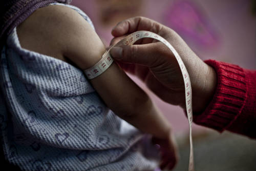 Midiendo el brazo de una niña con malnutrición